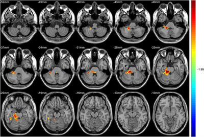 Altered Functional Hubs and Connectivity in Type 2 Diabetes Mellitus Without Mild Cognitive Impairment